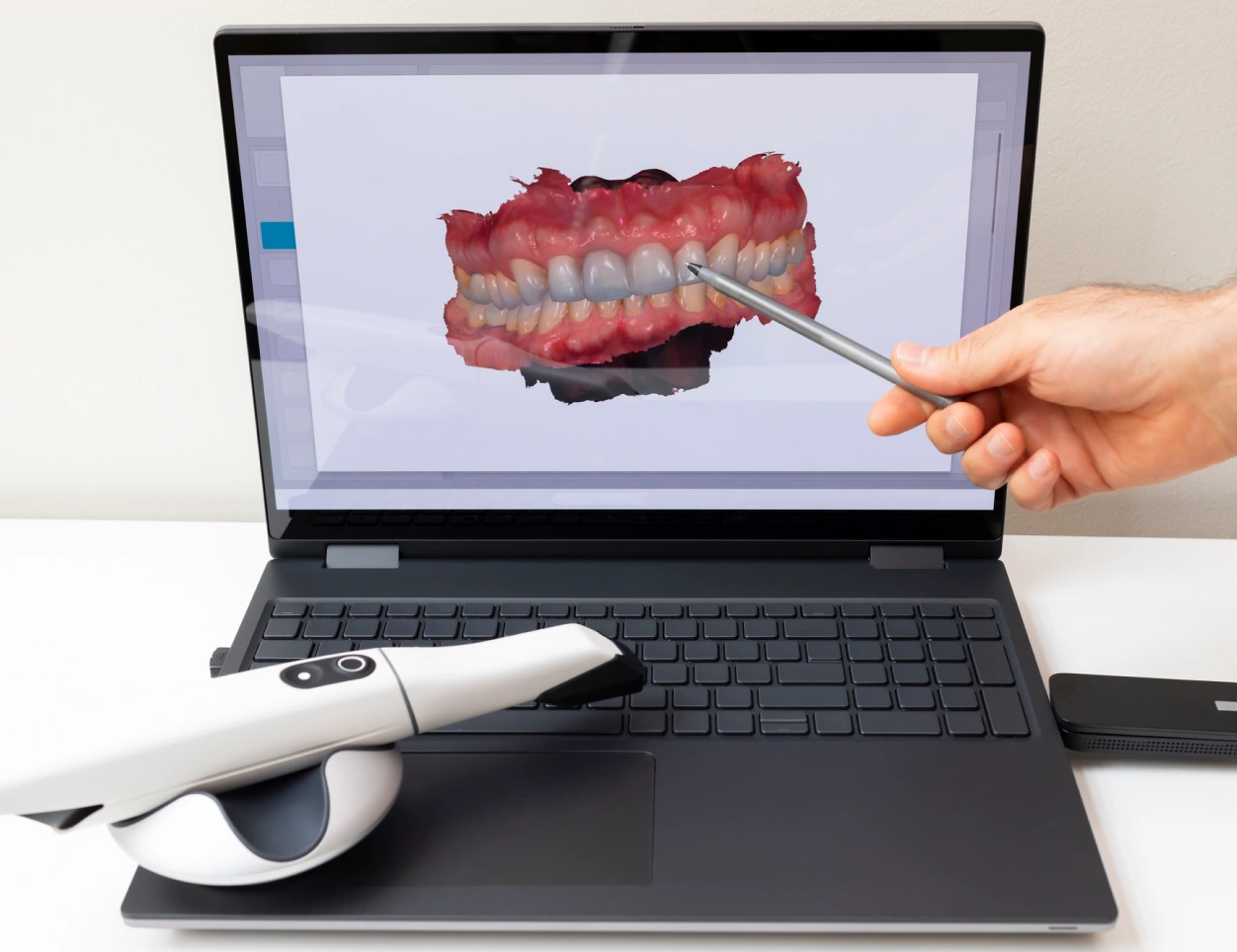 Dentist pointing at 3D dental model on laptop screen during consultation.