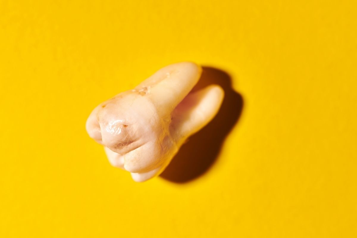 Wisdom Teeth