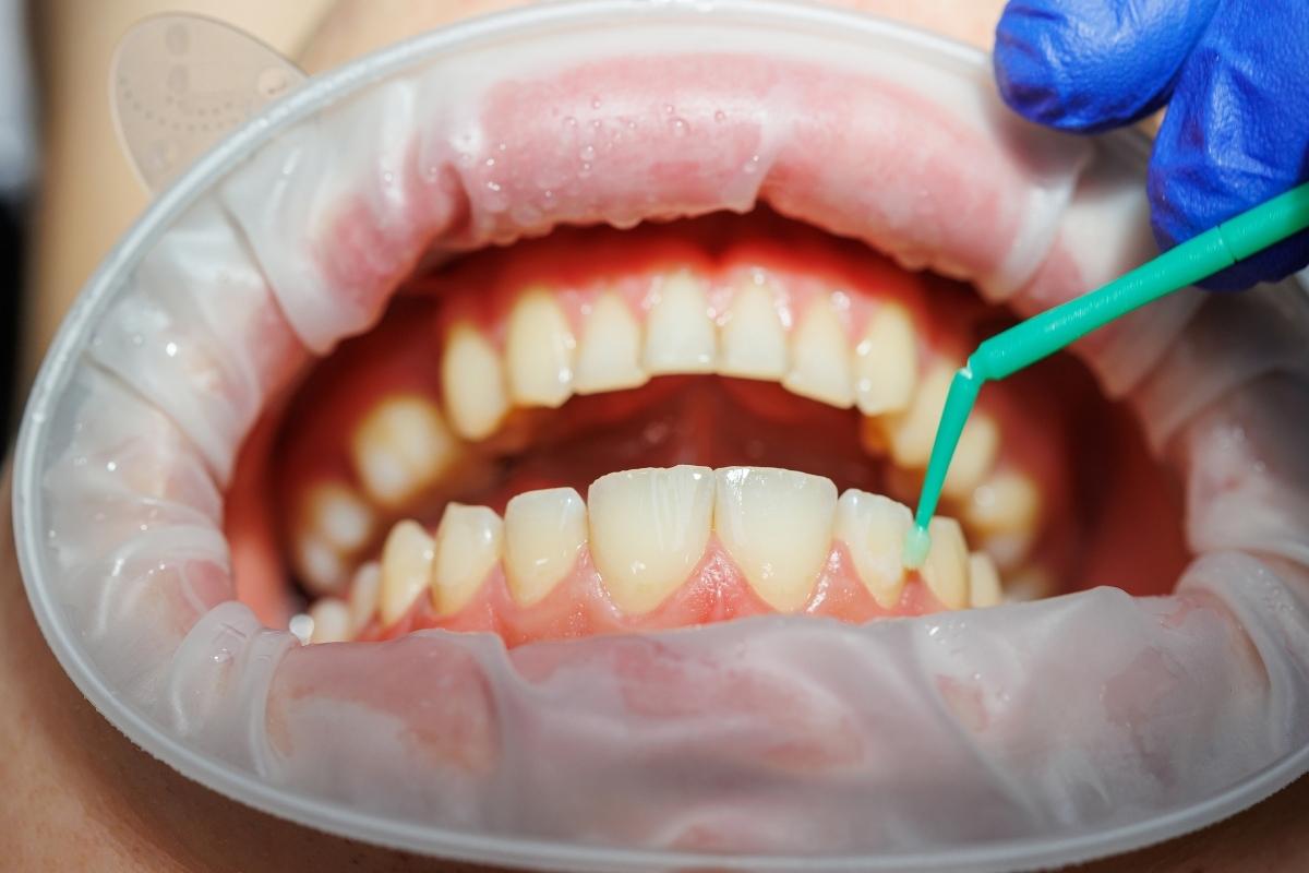 Yellow Teeth