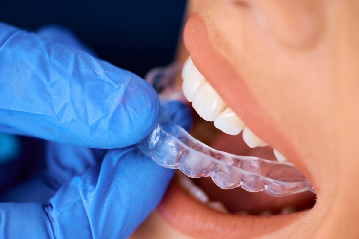 Orthodontic Treatment for Adults